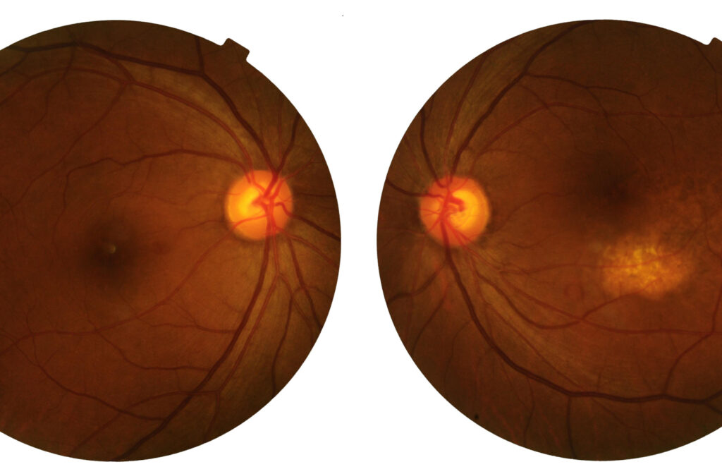 POV 2 images inside the eye showing pressure build up and damage to the optic nerve due to Glaucoma