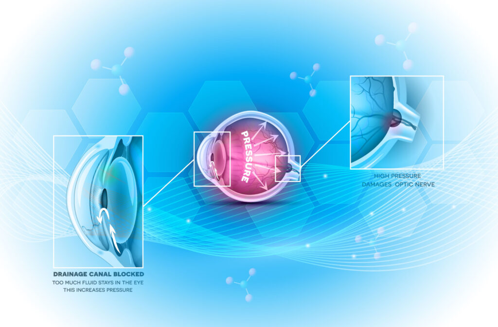 An illustration of an eye with glaucoma