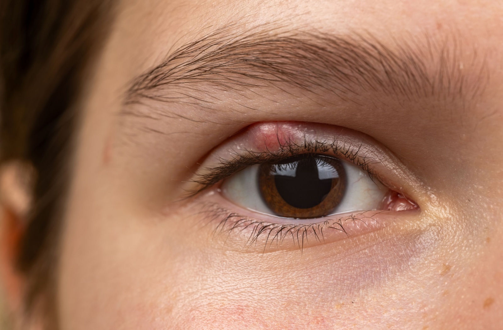 A person with an external stye on their eye as a result of poor hygiene.